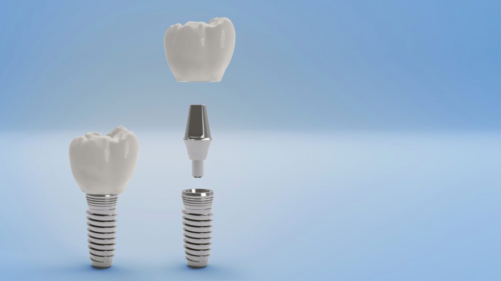 Dental Implants in Woodstock, Maryland