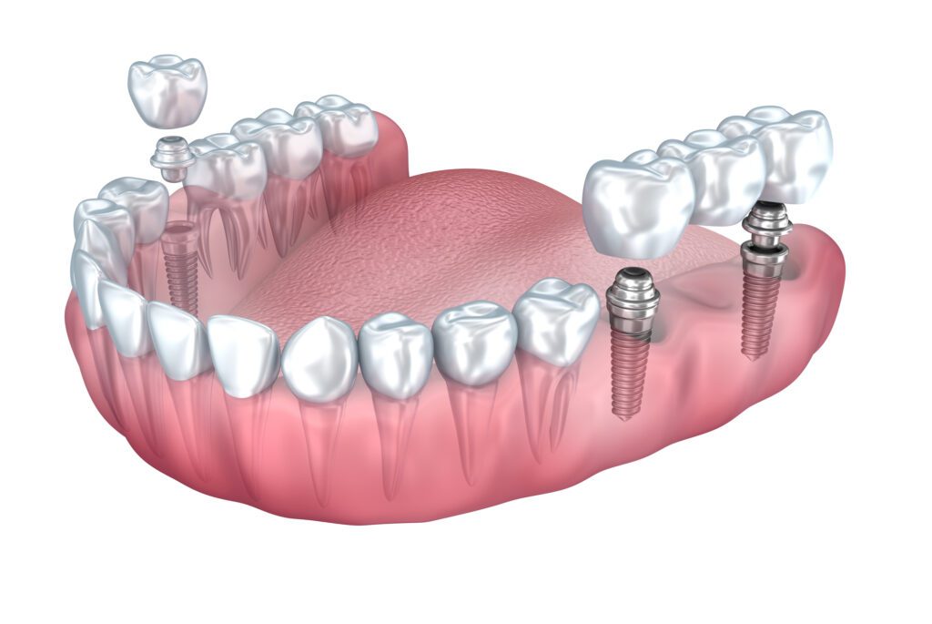 Dental Implants in Ellicott City, MD