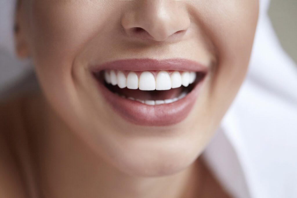 Porcelain Veneers