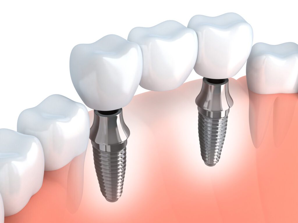 dental bridge in Ellicott City, MD