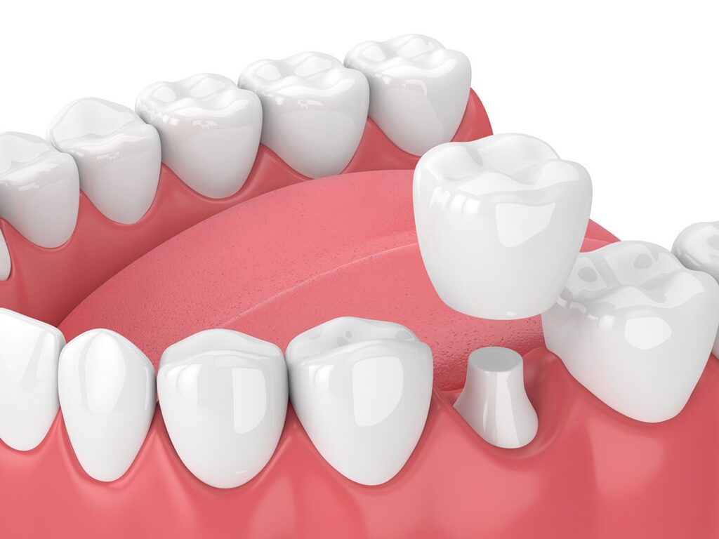 dental crown in Columbia, MD