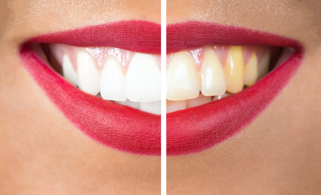 Over time, the effects of teeth whitening may diminish. Regular touchups can help keep your smile bright and vibrant.