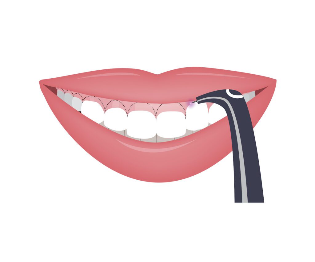 Patients often find laser dentistry less invasive than traditional methods. Understanding what to expect can help ease any concerns.