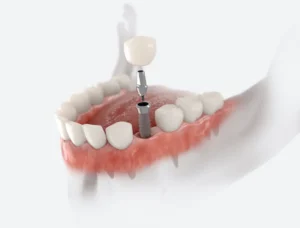 Dental Implants From Start to Finish in Woodstock, MD
