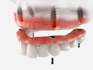 Can Dentures Be Comfortable? Modern Solutions in Woodstock, MD